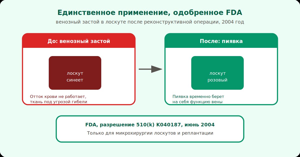 Единственное применение, одобренное FDA: венозный застой в лоскуте после реконструктивной операции